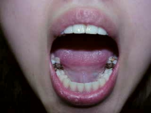 Gold teeth